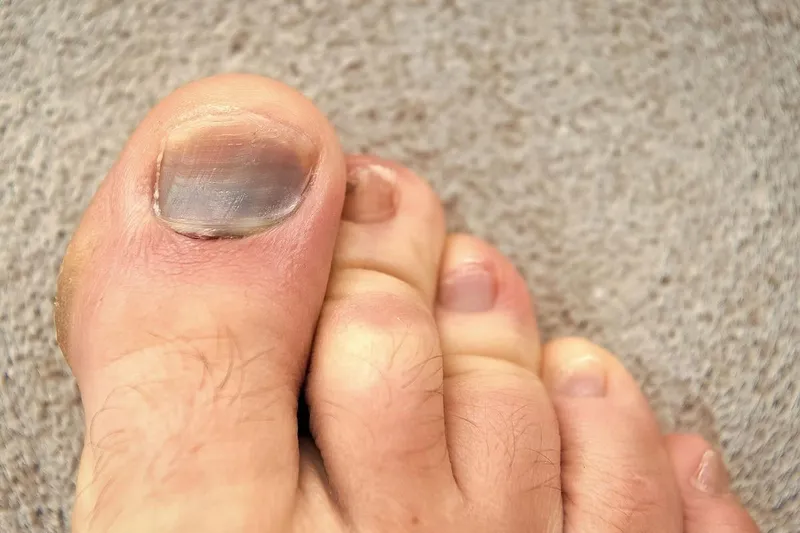 Hướng Dẫn Về Chăm Sóc Chân Khi Bị Bầm Móng Chân