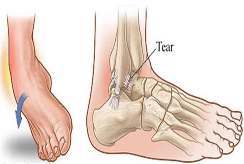Nguyên nhân thường gặp khiến bạn bị lật cổ chân (lật sơ mi) và các tình huống liên quan đến trợt té, vấp ngã trong sinh hoạt hàng ngày