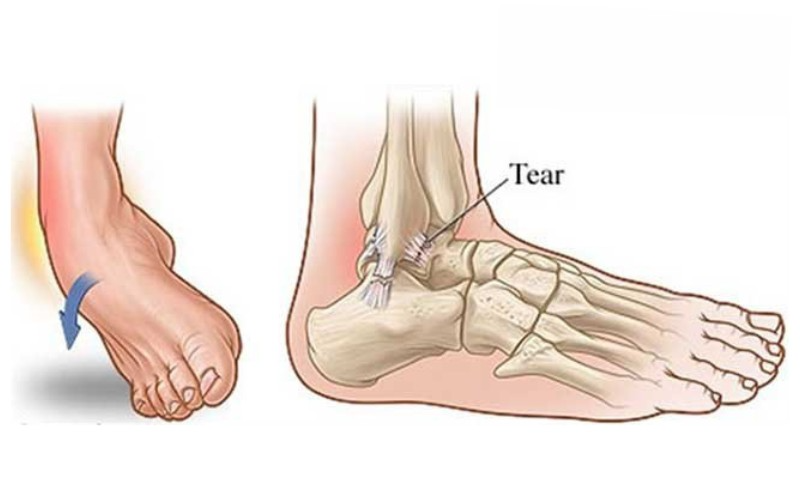 Xử lý ban đầu và các biện pháp tự điều trị khi bị lật sơ mi cổ chân
